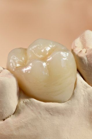 Dental crown over a tooth in model of the mouth
