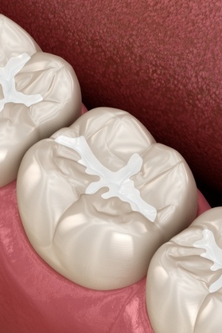 Animated row of teeth with dental sealants