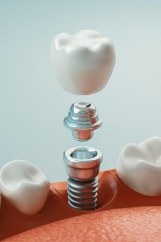 Animated dental implant with abutment and dental crown