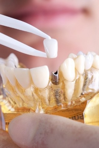 Dentist placing dental crown on model of dental implant