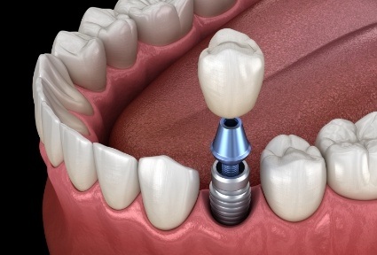 Animated dental implant with dental crown