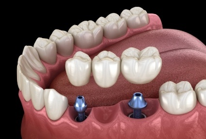 Two animated dental implants with dental bridge