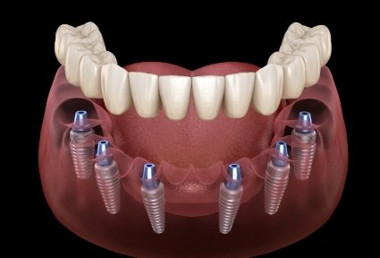 Six animated dental implants with full implant denture