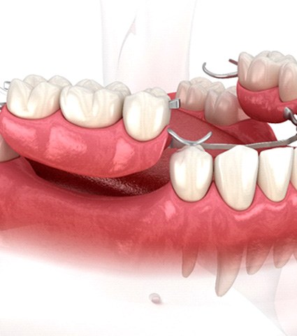 rendering of partial dentures