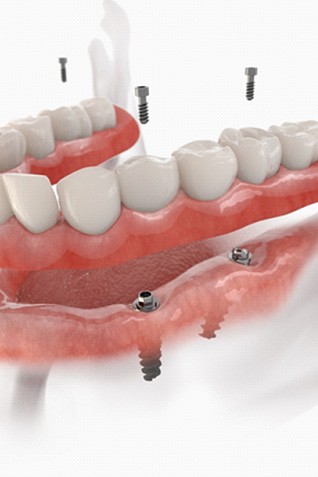 rendering of dental implant dentures