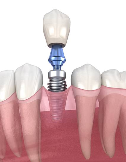 Model showing each part of a dental implant