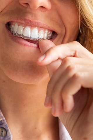 Closeup of woman smiling while putting on clear aligners