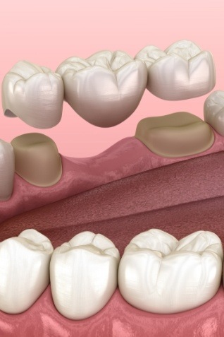 Animated dental bridge replacing a missing tooth