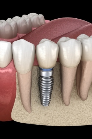 Animated dental implant in the lower jawbone