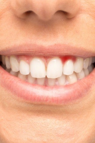 Close up of smile with red spot in gums