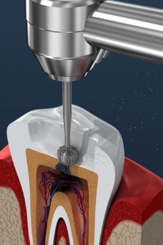 Animated illustration of tooth undergoing root canal treatment