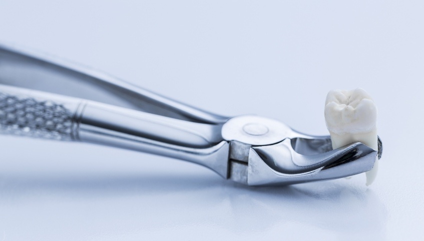 Dental forceps holding a tooth after tooth extraction in Arundel
