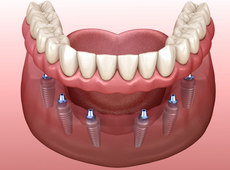 A 3D illustration of implant dentures