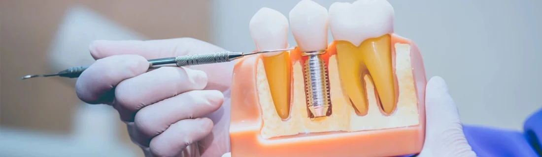 Dentist Arundel ME Dental Implant Model Held by Dentist Showcasing Process of Implant Dentistry Dental Implant Model Held by Dentist Showcasing Process of Implant Dentistry