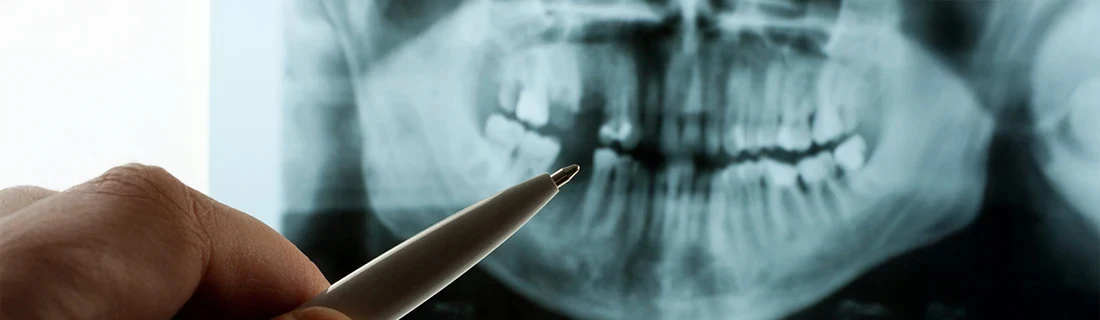 Dentist Arundel ME Doctor Pointing To Missing Tooth X-Ray Dental Technology Doctor Pointing To Missing Tooth X-Ray Dental Technology