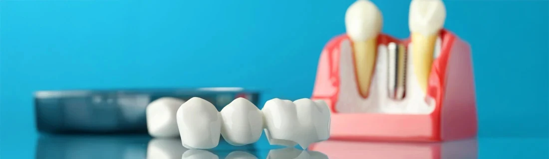 Dentist Arundel ME Various Methods of Replacing Teeth are Shown Missing Teeth Various Methods of Replacing Teeth are Shown Missing Teeth